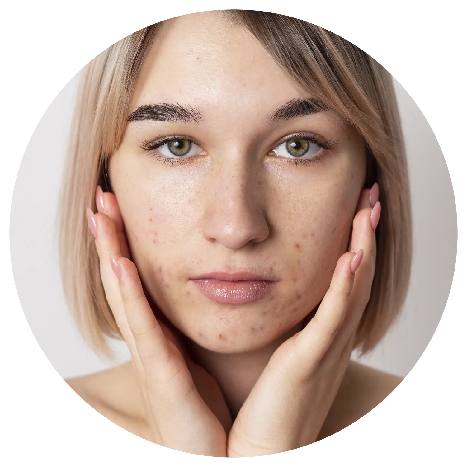 Active Acne treatment results at Toronto medical spa - The Chain Reaction of Symptoms